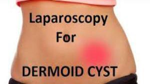 Laparoscopic Management of Ovarian Diseases DR RK Mishra Live Stream