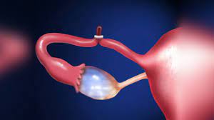 Laparoscopic myomectomy instead of hysteroscopic myomectomy for large submucous fibroid.