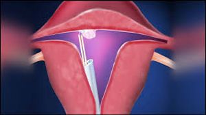 Myomectomy and Dermoid Ovarian Cystectomy