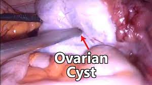 Laparoscopic Resection of a Torted Ovarian Dermoid Cyst