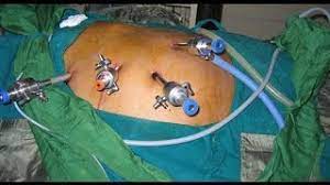 Robotic Cholecystectomy for Empyema Gallbladder