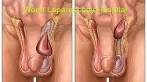 Laparoscopic Cervical Cerclage With Myomectomy