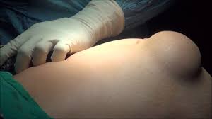 Laparoscopic Repair of Incisional Hernia