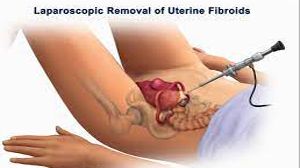 Laparoscopic Myomectomy for Intramural Fibroid