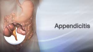 Laparoscopic Surgery for Ruptured Appendix