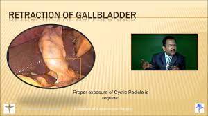 Adhesiolysis and Adhesion Prevension