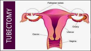 Laparoscopic Tubectomy by Tripolar