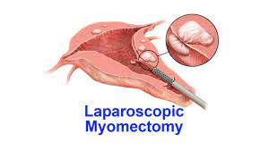 Dermoid Ovarian Cystectomy by Laparoscopy