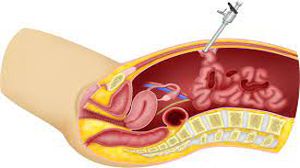 da Vinci Robotic Gastrojejunostomy during Gastric Bypass