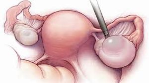 Robotic Ovarian Cystectomy