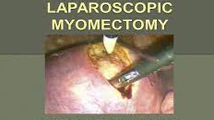 Laparoscopic Heller's Myotomy For Achalasia