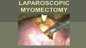 Laparoscopic Myomectomy and Salpingo-oophorectomy with Palmer's Point and Extraction by Colpotomy