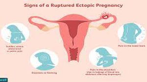 गर्भाशय की रसौली: बच्चेदानी में गांठ होने के लक्षण, कारण, इलाज व बचाव के बारे में जानें