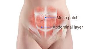 Laparoscopic Repair of Paraumbilical Hernia