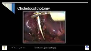 Laparoscopic Sterilization Lecture by Dr R K Mishra