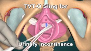 Laparoscopic Management of Perforated Appendicitis