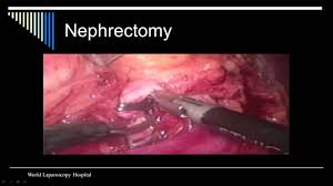 DR R K Mishra Live Stream Lecture on Total Laparoscopic Hysterectomy
