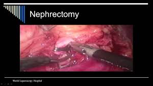 Minimally Invasive Surgical Treatment of Stone in Gallbladder