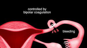 IPOM Laparoscopic Inguinal Hernia Repair