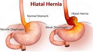 Laparoscopy Hysterectomy