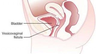 Laparoscopic Surgery for Symptomatic Retroverted Uterus