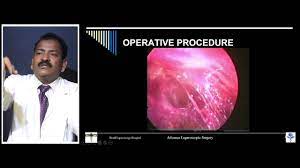 Laparoscopic Myomectomy