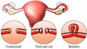 Laparoscopy Hysterectomy