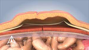 Laparoscopic Weston Knot