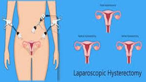 Laparoscopic Appendectomy for Acute Appendicitis in Pediatric Patient