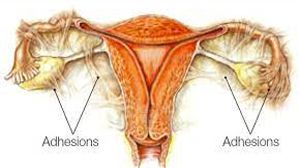 Laparoscopic tubal sterilization