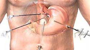 Role of Laparoscopy in Cancer Surgery