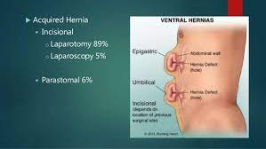 Recurrent Hernia Laparoscopic Repair