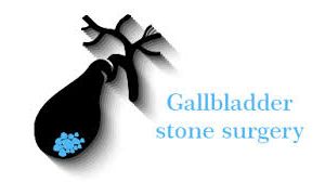 Gallbladder Stone Surgery