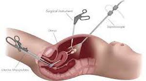 Total Laparoscopic Hysterectomy (TLH) by Three Port and Infrared Ureteric Cathete