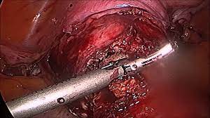 Bilateral Salpingooophorectomy