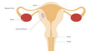 Exploring the Surgical Dilemma: Laparoscopy's Contraindication in Generalized Severe Peritonitis