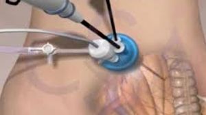 Total Laparoscopic Hysterectomy with ligation of Uterine Artery by Dr R K Mishra