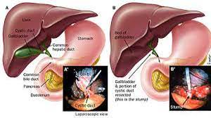 Laparoscopic Ovarian Cystectomy for Right Sided Dermoid Cyst