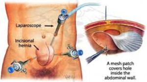 Laparoscopic Ventral Hernia repair by Dr R K Mishra