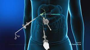 Laparoscopic Surgery for Gall Stone