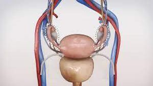 Laparoscopic Resection of a Torted Ovarian Dermoid Cyst