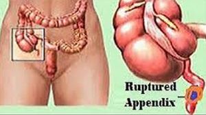 Laparoscopic Management of Ruptured Appendix