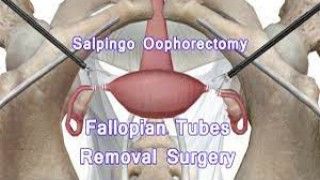 Salpingo Oophorectomy for Large Ovarian Cyst