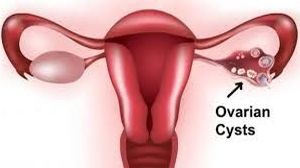 Laparoscopic Ovarian Cystectomy and Myomectomy by Dr R K Mishra