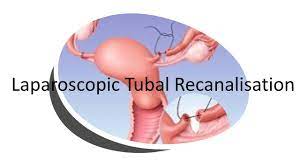 Laparoscopic Tubal Recanalization Surgery