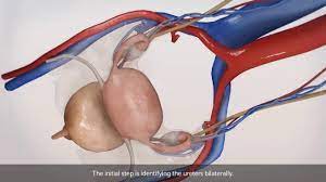 Laparoscopic Myomectomy by Mishra's Knot