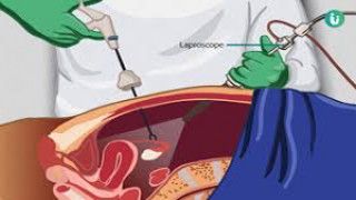 Total Laparoscopic Hysterectomy by Ligation of Uterine artery