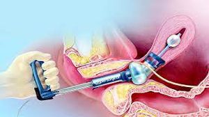 Uterine Manipulator