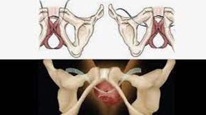 Myomectomy and Dermoid Ovarian Cystectomy