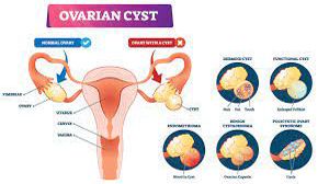 Ovarian cystectomy for Left Ovarian Cyst